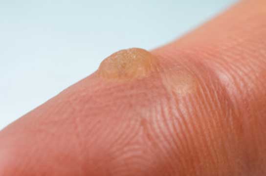 Salicylic có khả năng trị được những mụn cóc trên da