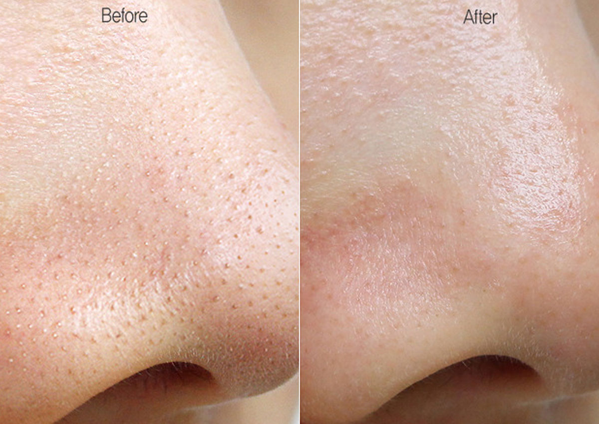 Mụn cám là gì? 5 cách điều trị mụn cám hiệu quả nhất