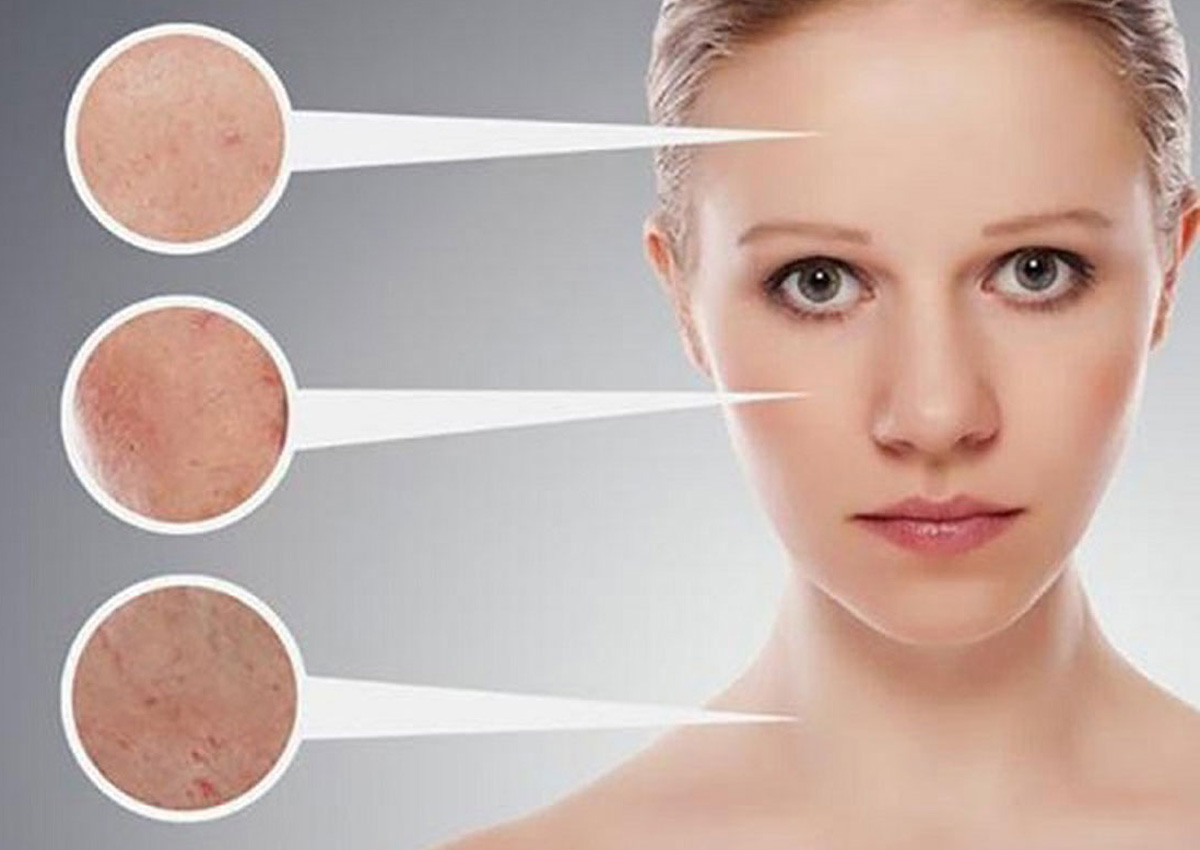 TOP 7 Cách trị mụn cám hiệu quả cho mọi loại da