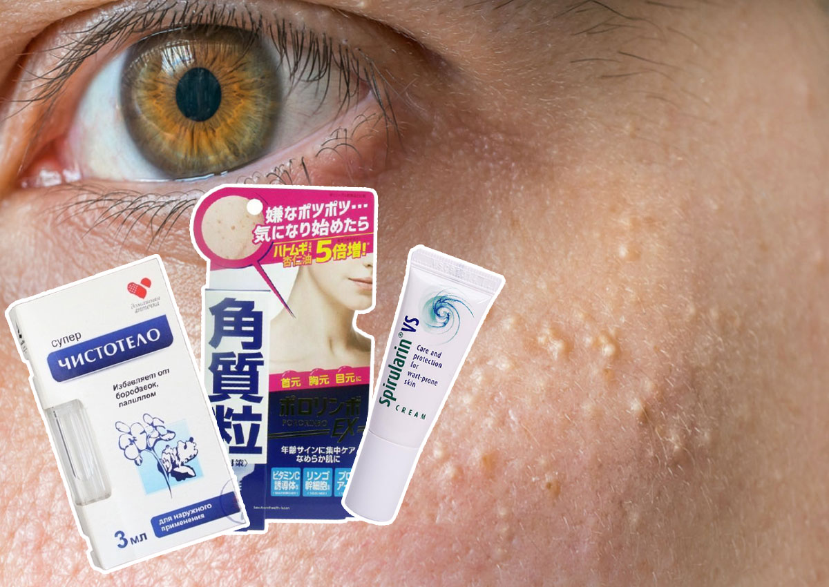 [REVIEW] Top 5 thuốc trị mụn thịt tốt nhất hiện nay